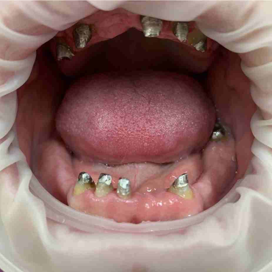 Коронка на передние зубы в Омске по доступной цене качественно и в срок