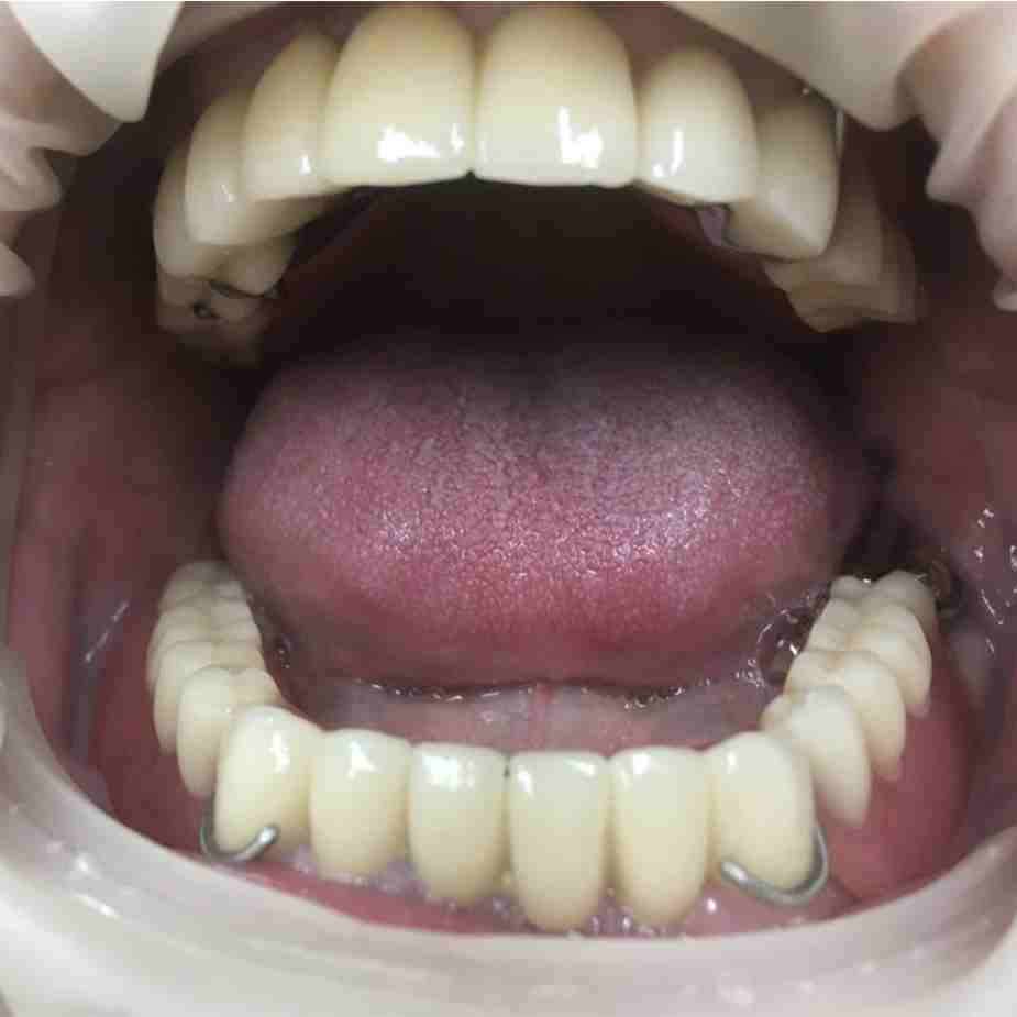 Вставить 3 зуба и более в Омске по доступной цене качественно и в срок