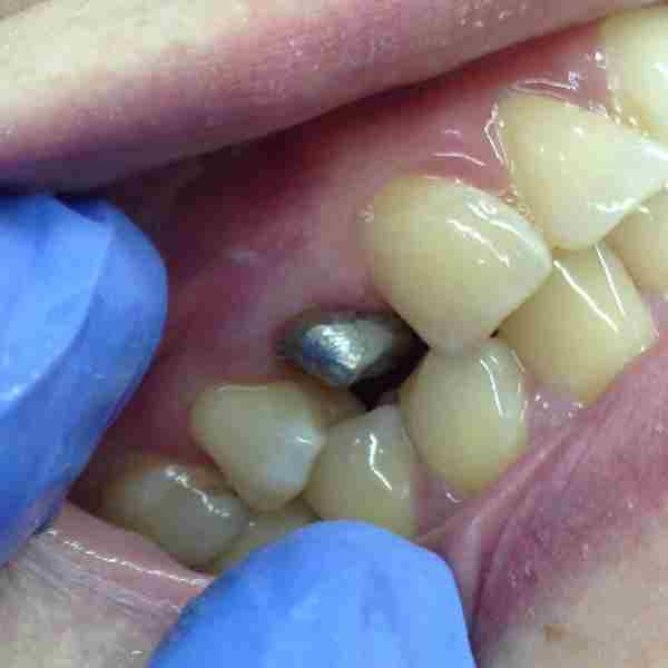 Частичный съемный зубной протез в Омске по доступной цене качественно и в срок
