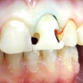 Реставрация передних зубов по доступной цене в Омске в клинике Харизма недорого 