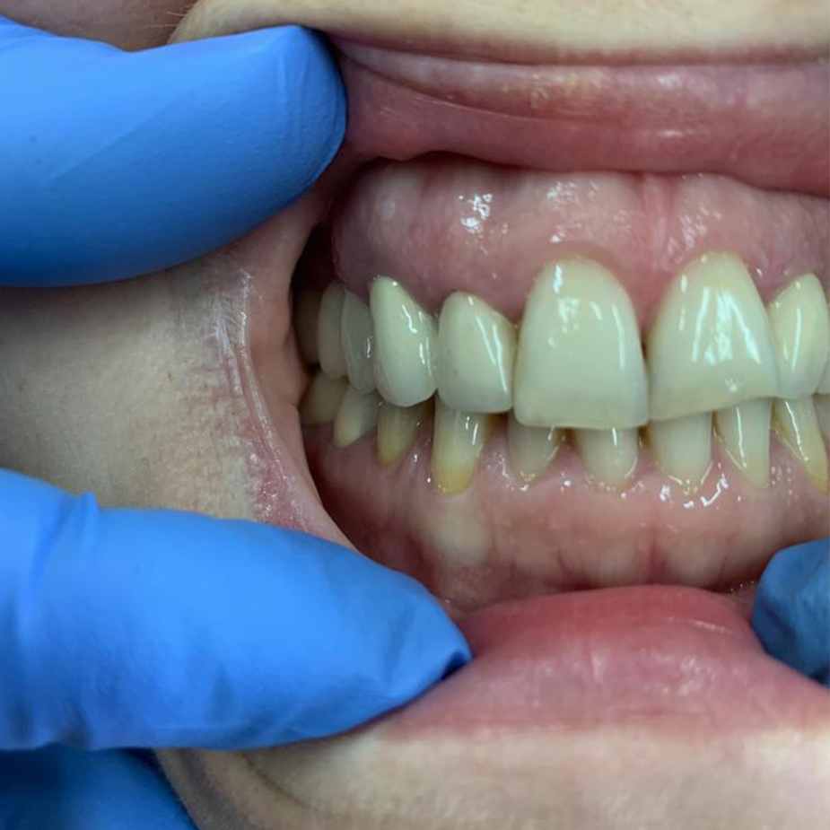 Частичный съемный зубной протез в Омске по доступной цене качественно и в срок